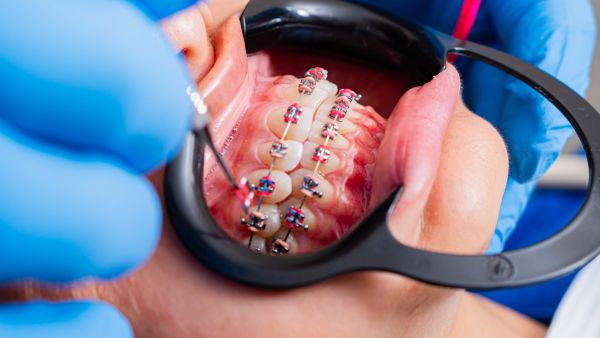 Découvrez comment choisir un orthodontiste à La Madeleine